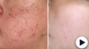 تجربة على آثار الحبوب